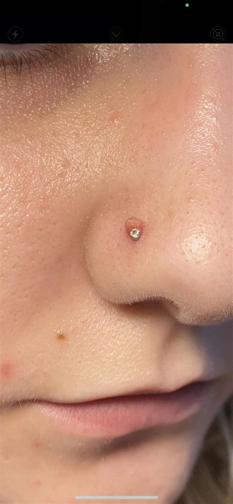 keloid nose ring|nose piercing irritation inside.